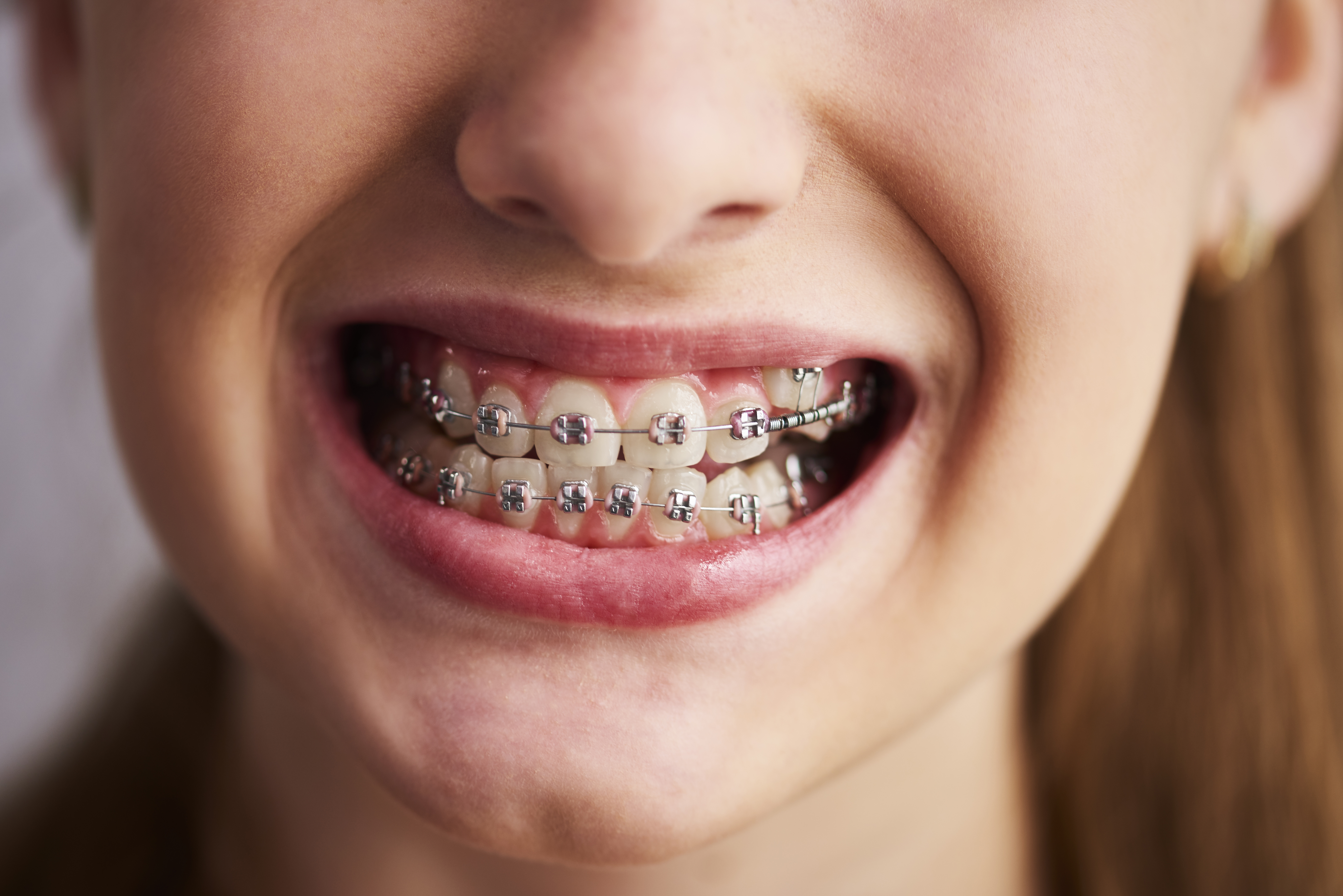 dental braces