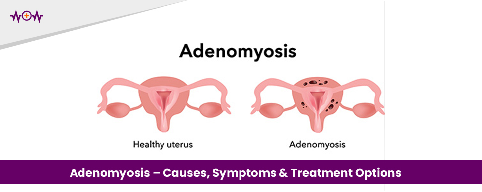 Adenomyosis – Causes, Symptoms & Treatment Options