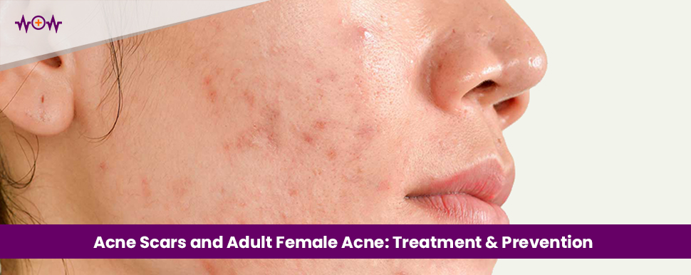 Acne Scars and Adult Female Acne: What They Are, How to Prevent Them, And Treat Them
