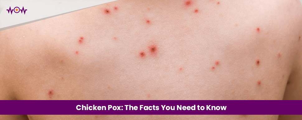 Chicken Pox: The Facts You Need to Know
