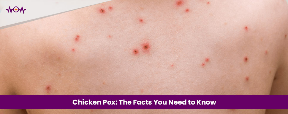 Chicken Pox: The Facts You Need to Know - WoW Health