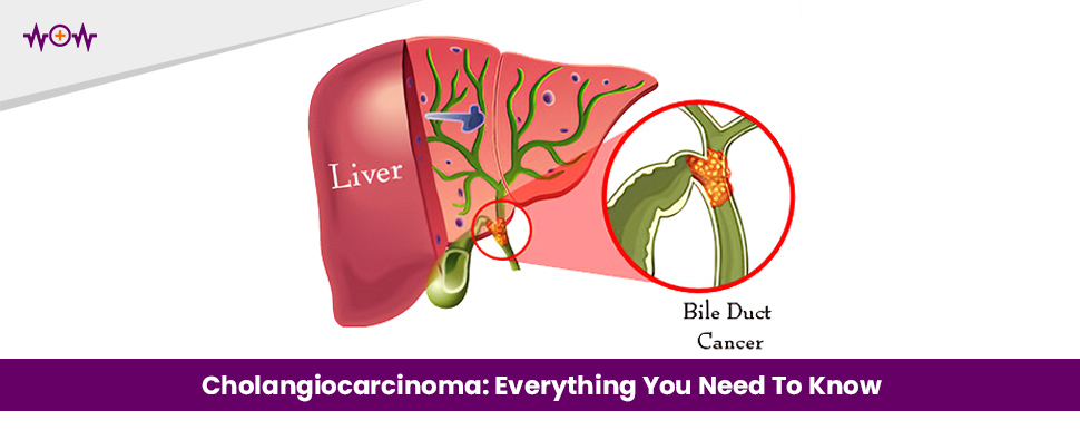 Cholangiocarcinoma: Everything You Need To Know