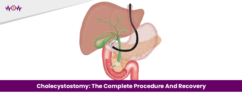 cholecystostomy-the-complete-procedure-and-recovery