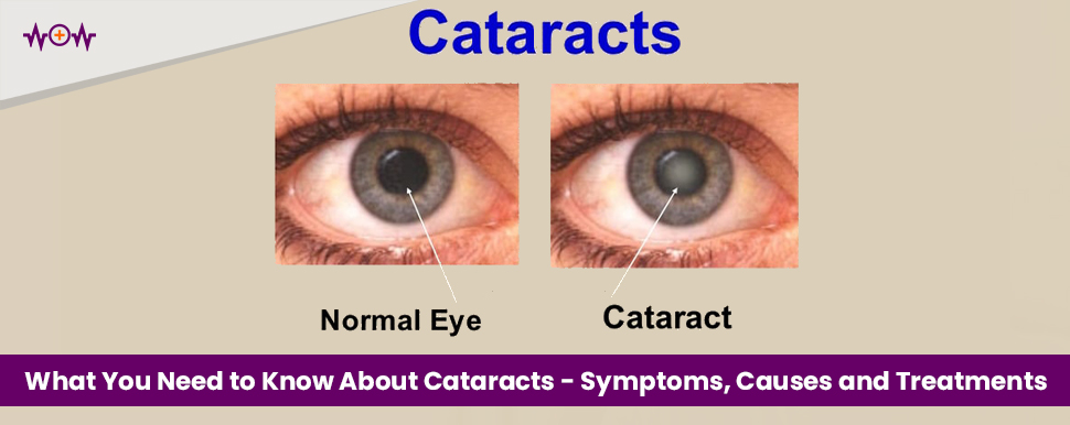 What You Need to Know About Cataracts – Symptoms, Causes and Treatments