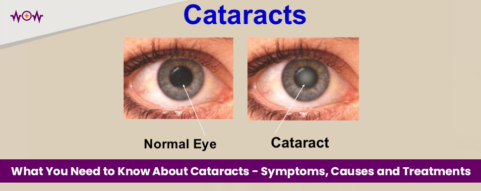 what-you-need-to-know-about-cataracts-symptoms-causes-and-treatments