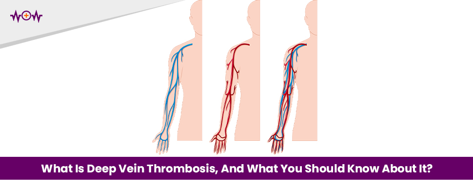 what-is-deep-vein-thrombosis-and-what-you-should-know-about-it