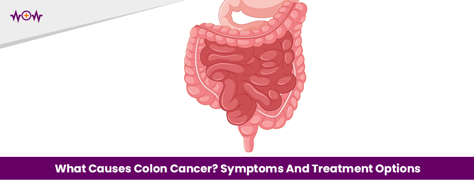 What Causes Colon Cancer? Symptoms And Treatment Options