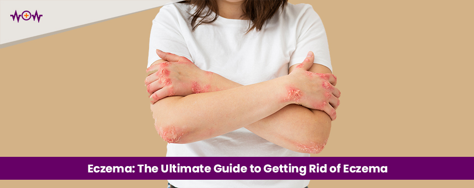 Eczema: The Ultimate Guide to Getting Rid of Eczema