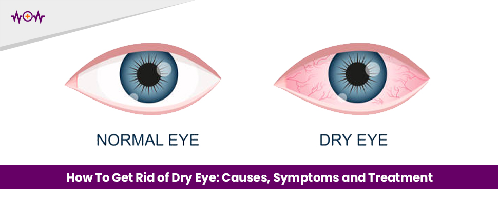 How To Get Rid of Dry Eye: Causes, Symptoms and Treatment