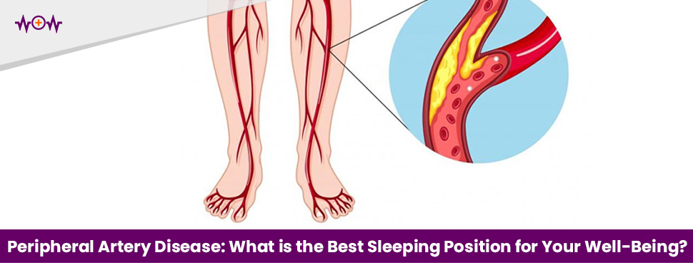 Peripheral Artery Disease: What is the Best Sleeping Position for Your Well-Being?