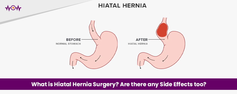What is Hiatal Hernia Surgery? Are there any Side Effects too?