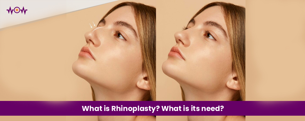 What is Rhinoplasty? What is its need?