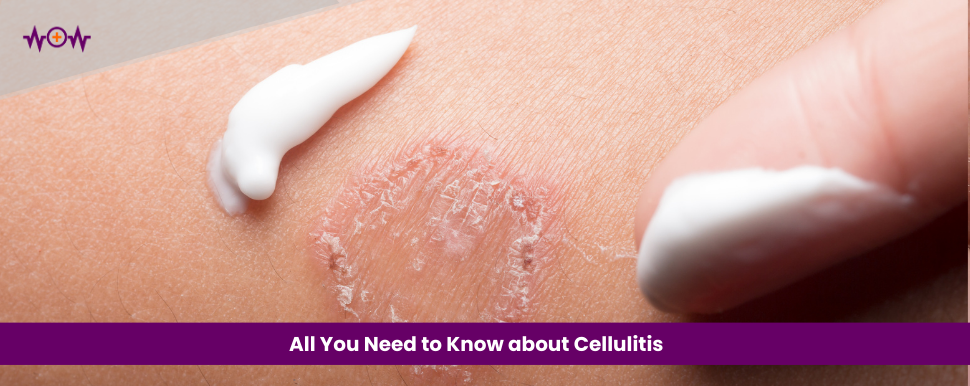 All You Need to Know about Cellulitis