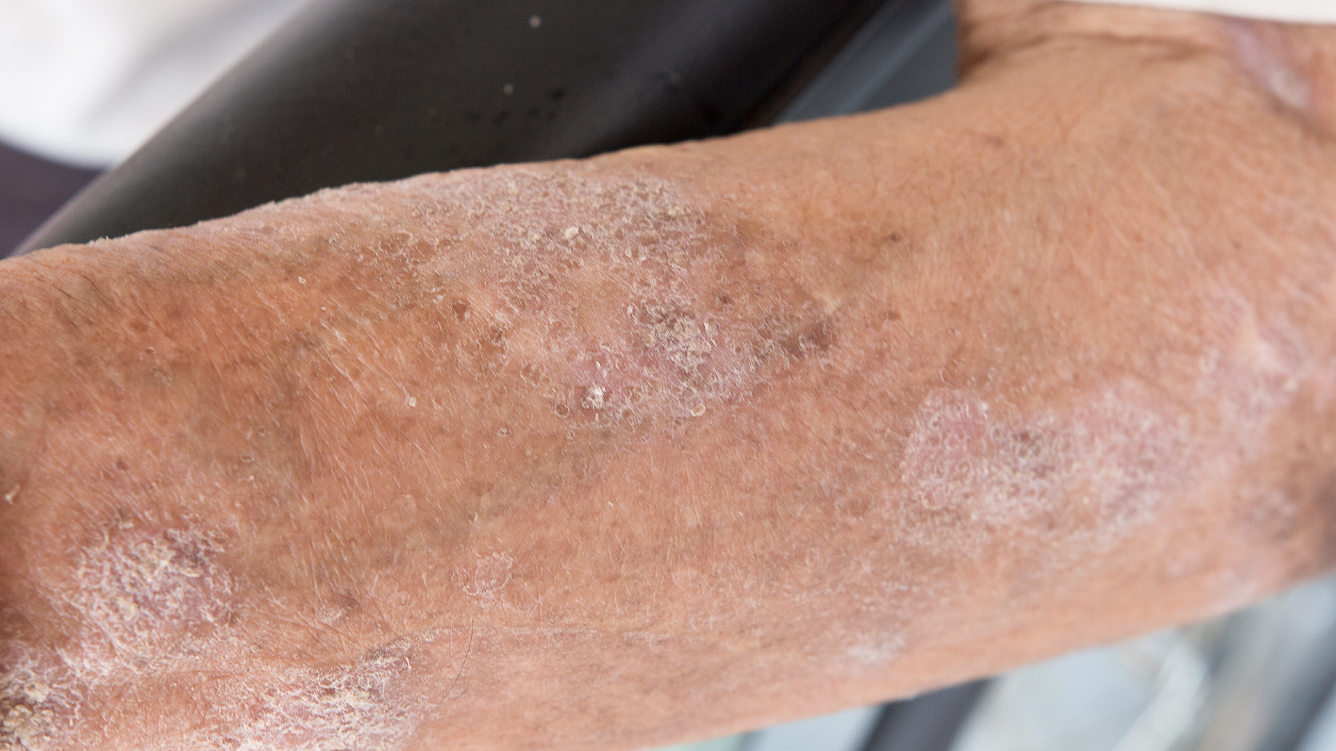 All You Need to Know about Cellulitis