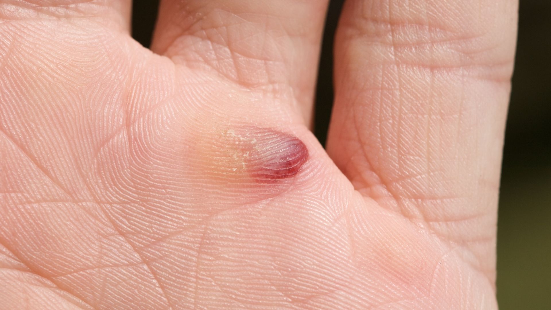 What Are The Causes Symptoms And Treatment Of Blood Blisters