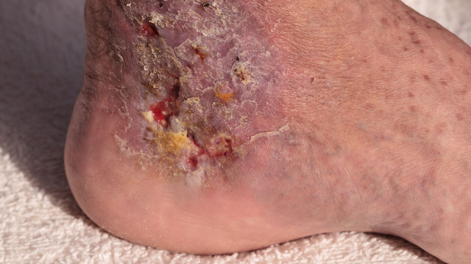 All You Need to Know about Cellulitis