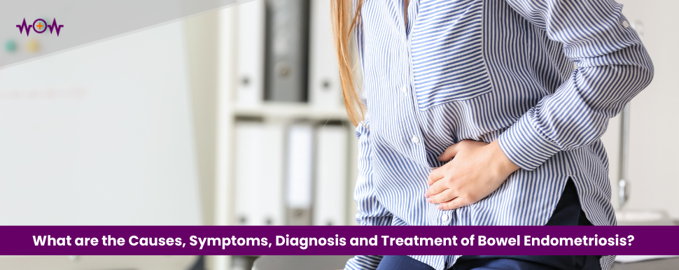 What are the Causes, Symptoms, Diagnosis and Treatment of Bowel Endometriosis?