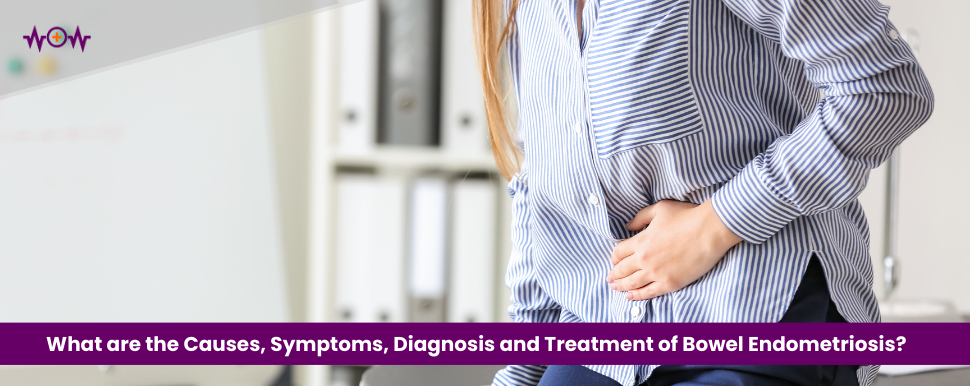 what-are-the-causes-symptoms-diagnosis-and-treatment-of-bowel-endometriosis