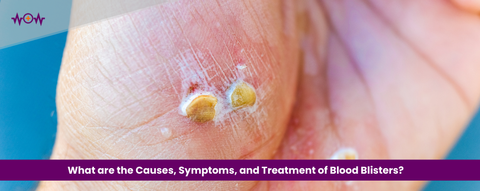 What are the Causes, Symptoms, and Treatment of Blood Blisters?