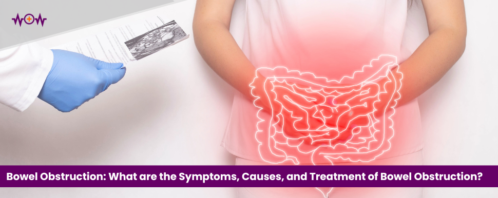 Bowel Obstruction: What are the Symptoms, Causes, and Treatment of Bowel Obstruction?