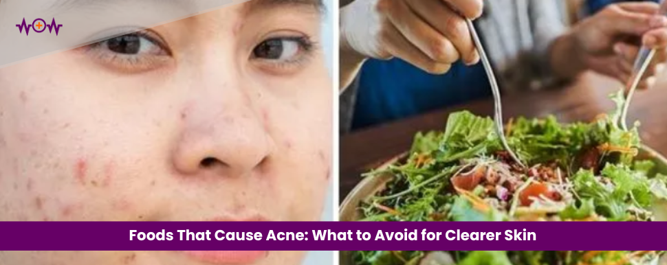Foods That Cause Acne: What to Avoid for Clearer Skin