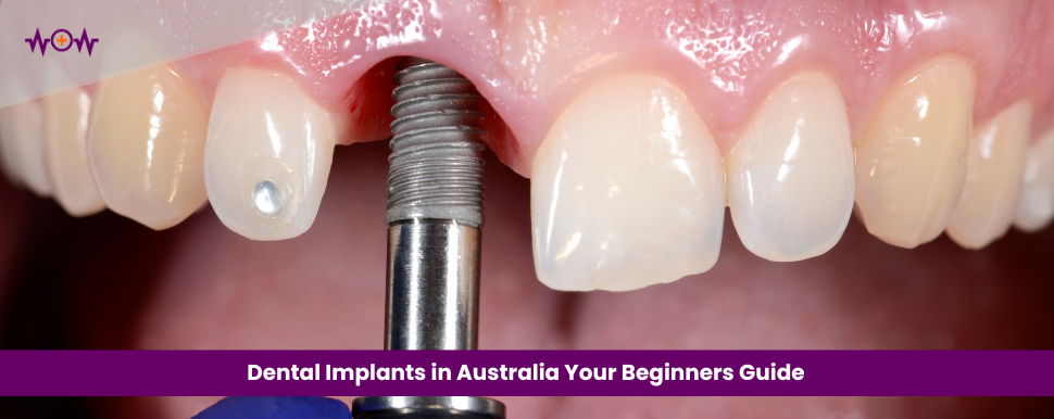 Beginner’s Guide to Dental Implants