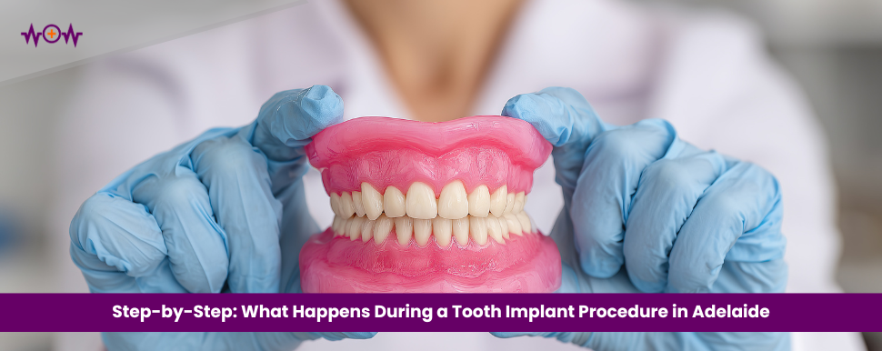 Step-by-Step: What Happens During a Tooth Implant Procedure in Adelaide