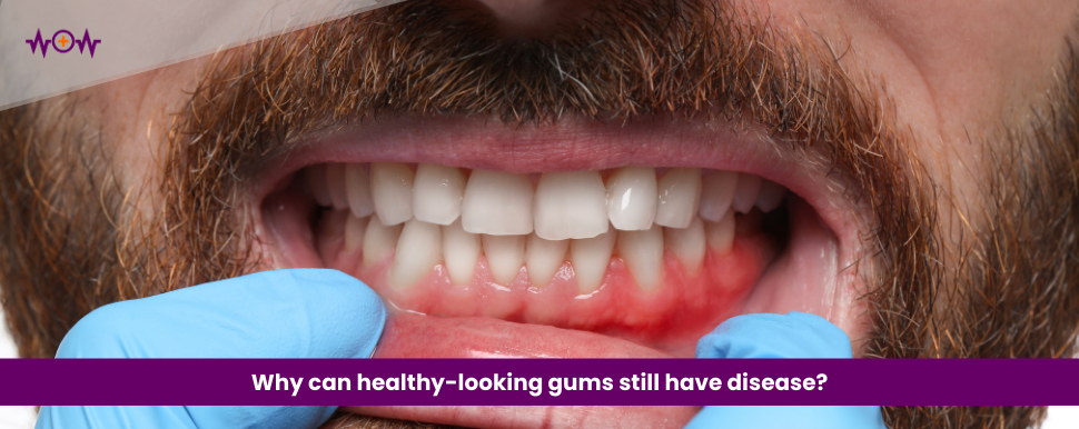 Why can healthy-looking gums still have disease?