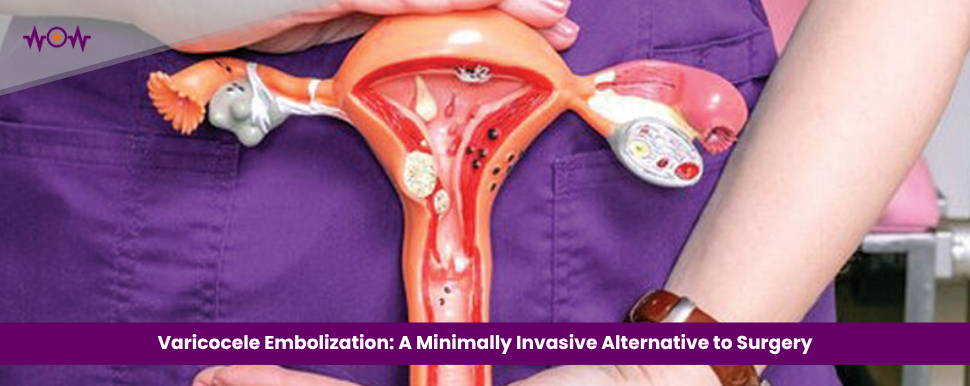Varicocele Embolization: A Minimally Invasive Alternative to Surgery