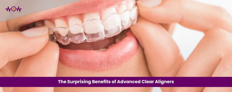 The Surprising Benefits of Advanced Clear Aligners